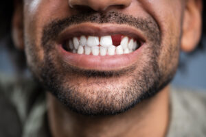 El Paso, TX, dentist offers bridges and dentures to address tooth loss 