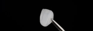 el paso veneers
