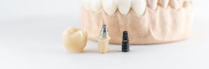 el paso dental implants