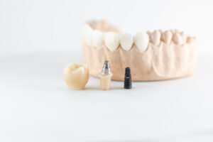el paso dental implants