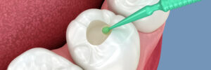 el paso dental fillings