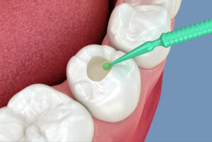 el paso dental fillings