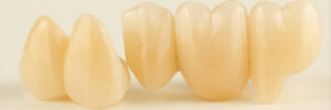el paso dental bridge